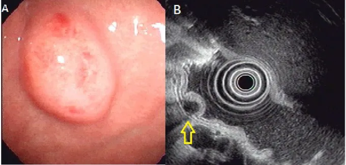 Figure 4. Ectopic pancreas originates from the fourth sonographic layers of the gastric wall.