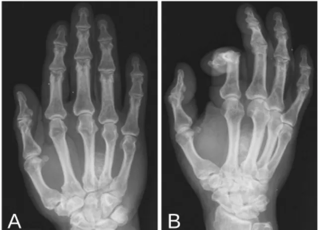 Fig. 1. A: Radiograph of hand in AP projection shows a mass lesion of high density at the soft tissue between the third and fourth fingers