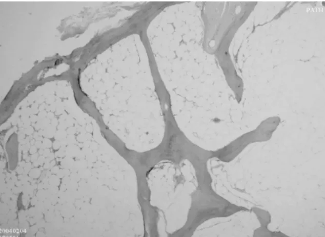 Fig. 3. The mass consisted of normal bone trabeculae and fatty tissue.