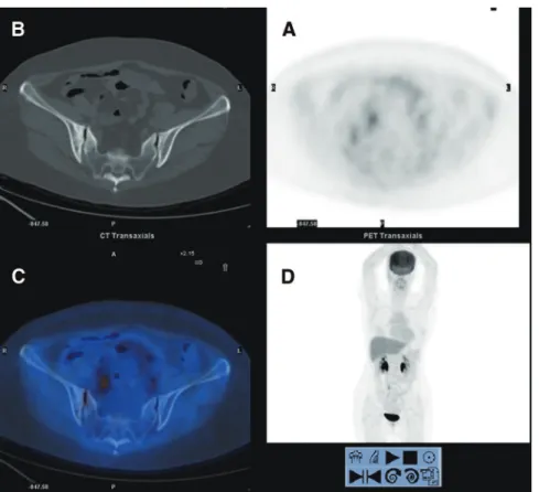 FIGURE 3. The patient underwent FDG PET/CT again at 2-year follow-up. The transaxial PET (A), CT (B), fused PET/CT (C), and MIP (D) images revealed only mild FDG uptake in right sacroiliac joint with a maximum standardized uptake value of 2.17, showing sig