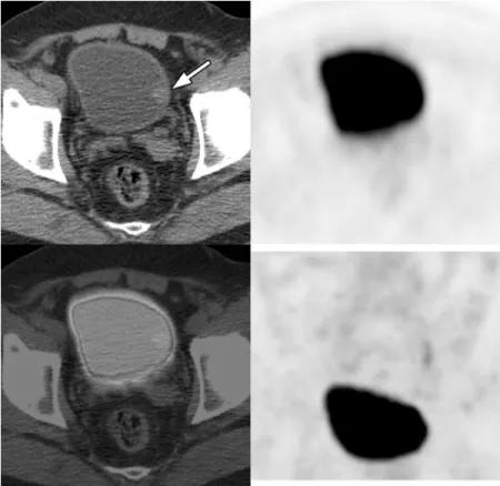 FIGURE 1. A 71-year-old man had undergone right nephrectomy for renal cell carcinoma about 2 years ago without symp- symp-toms and signs suggestive of recurrence during the regular follow-up