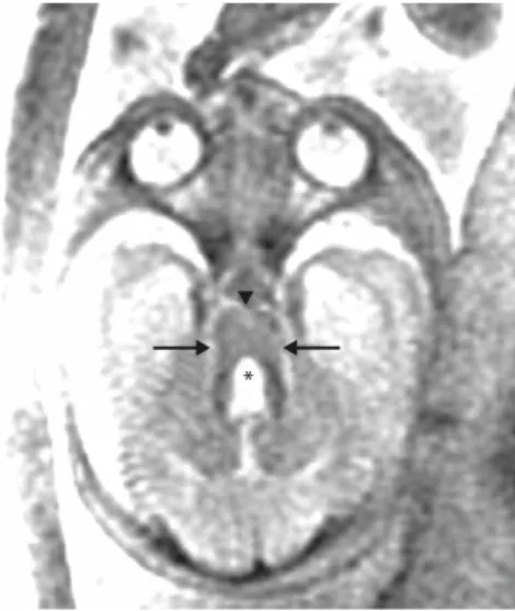 Figure 1. A male fetus at 27 weeks’ gestation with abnormal magnetic resonance imaging findings suggestive of Joubert syndrome