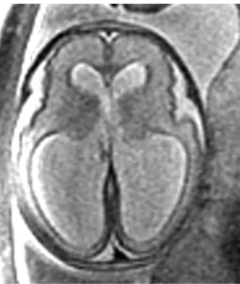 Figure 3. Prenatal axial imaging shows ventriculomegaly with dilation of the lateral ventricles.
