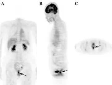 Fig. 2. The FDG-PET images show an area of increased FDG uptake in the anal region (arrows)