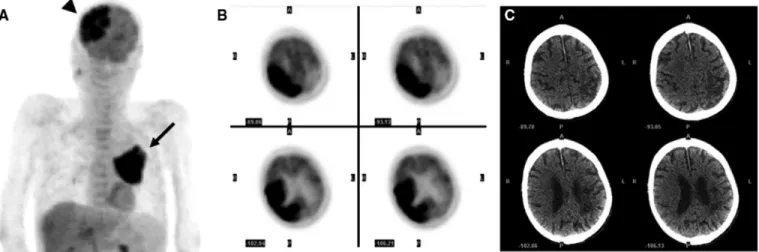 FIGURE 2. MRI of brain, shown here with diffu- diffu-sion-weighted (A), FLAIR (B), T2-weighted (C), and T1-weighted with contrast enhancement (D), was performed for further evaluation