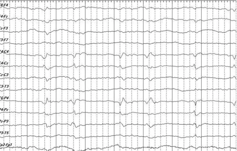 FIGURE 3. The associated symptoms/signs of the patient included left limb weakness, mental confusion, and occasional right facial twitching