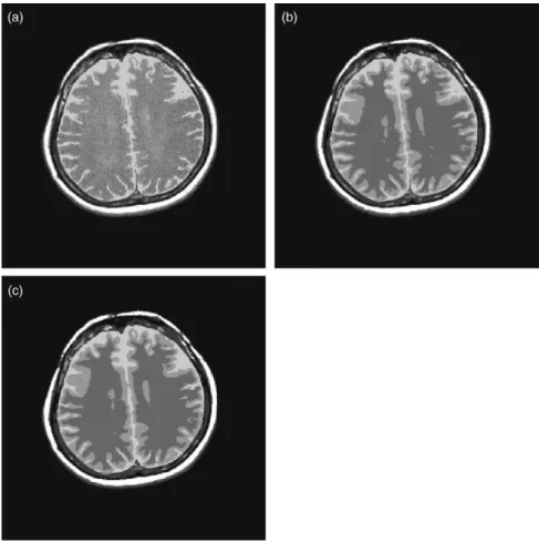 Fig. 3. Segmented images of a noisy MRI image using (a) standard FCM; (b) sFCM 1,1 ; (c) sFCM 0,2 .