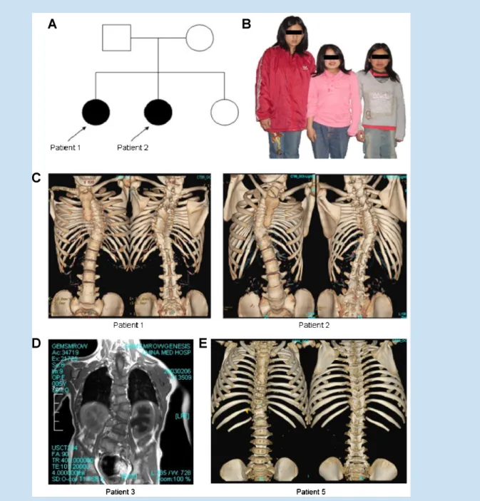 FIG. 1. A: The pedigree of the two representative patients (i.e., Patients 1 and 2). B: Patients 1 and 2 show short stature (with shortened trunk) and congenital scoliosis while their younger sister (left) shows normal stature
