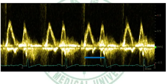 Fig 15. A representative intra-cardiac electrocardiogram. AS= atrial sensing,  VP= ventricular pacing, AP= atrial pacing 