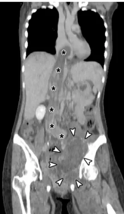FIGURE 1. A 24-year-old woman presented with progressive pain in the left groin and left buttock for 4 months