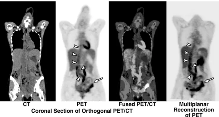 FIGURE 2. The FDG PET/CT showed heterogeneous distribution of abnormally increased FDG radioactivity (maximum SUV ⫽ 4.1) in the left pelvic cavity (arrows), corresponding to the pelvic mass disclosed on the contrast-enhanced CT