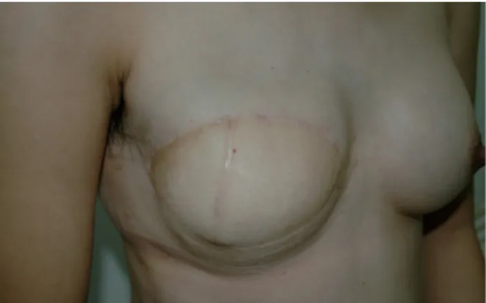 FIGURE 2. Example of a patient in whom a relatively large  amount  (88%,  375/425  g)  of  tissue  across  a  midline  scar  was successfully included in a DIEP flap