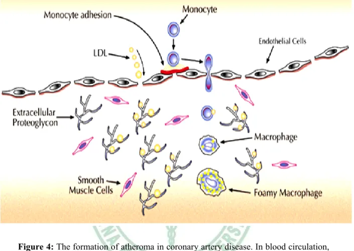Figure 4: The formation of atheroma in coronary artery disease. In blood circulation,  when LDL is increase, monocytes then adhere into the endothelial layer