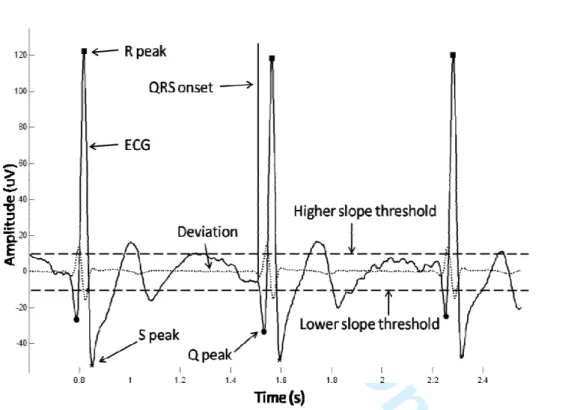 Fig. 3 QRS detection in the normal ECG waves. The black curve means the  normal ECG signal in which contains three waves