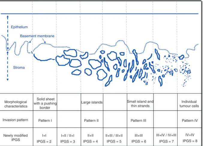 Figure 1. Diagrammatic illustrations and comparisons of four main patterns of invasion (POI) with corresponding IPGS of OSCC.