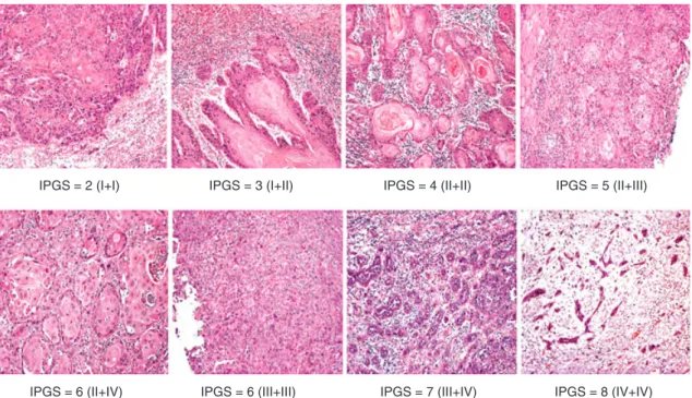 Figure 2. Representative microscopic photographs of OSCC with assigned IPGS from 2 to 8 (H&amp;E stain, ·200).