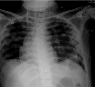 Fig.  3.  Failure  to  untie  the  knot  with  guidewire  under fluoroscopy.