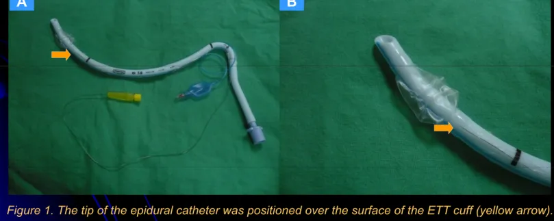 Figure 1. The tip of the epidural catheter was positioned over the surface of the ETT cuff (yellow arrow).