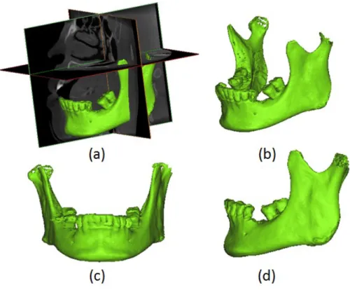 Figure 1. (a) The 3 orthogonal sections of the dental CBCT; (b) 3D model of the mandibular bone from the same angle as (a); (c) frontal view of the mandible rotated to a horizontal plane and parallel to the occlusal plane; and (d) side view of the mandible