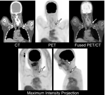 FIGURE 3. After reexamining the aforementioned follow-up MRI, we noticed a small, well-circumscribed, hyperintense lesion with relatively central hypointensity in the left lower neck region on the T2-weighted image with fat suppression (arrow)