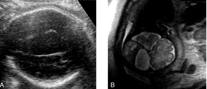 Fig. 1. A: Ultrasound showing supratentorial arachnoid cyst. B: MRI precisely locates the cyst and its involvment with peripheral brain structures.