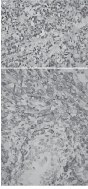 Fig 1.  A .  T h e  h i s t o l o g i c  f i n d i n g s  f r o m  t h e  TURP  specimen  revealed  diffused   infil-tration  of  neoplastic  cells  (400X)