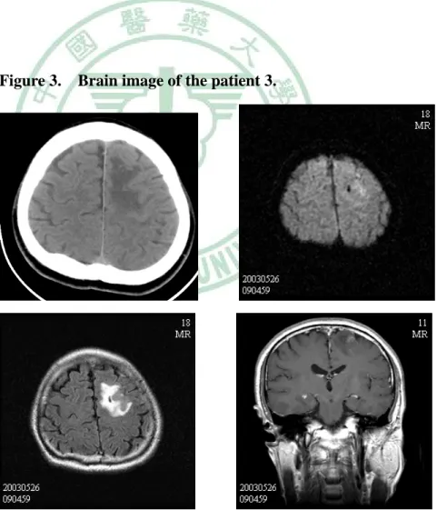 Figure 2.    Brain image of the patient 2. 