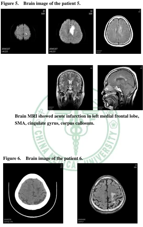 Figure 5.    Brain image of the patient 5. 