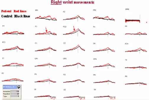 Figure 7. Grand Averages of the MRCPs for patient group (red lines) and the  control group (black lines)