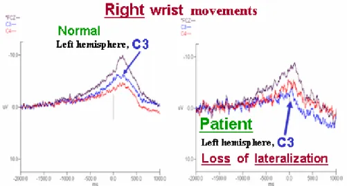 Figure 9. Loss of lateralization in patient group as comparing amplitude of C3  with C4 during right wrist movement