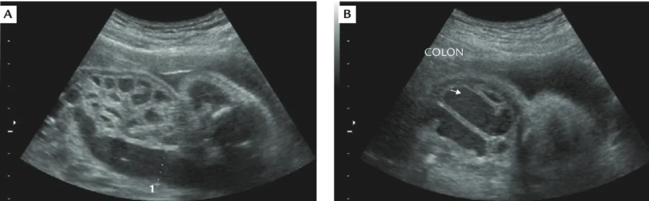 Figure 1. Prenatal ultrasound at 29 gestational weeks showing (A) a honeycomb appearance of multiple dilated loops of bowel and (B) fluid-filled large bowel.
