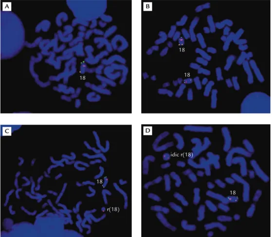 Figure 5. Fluorescence in situ hybridization studies of four types of cells with an 18p terminal probe RP11-324G2 (spectrum green), an 18q terminal probe RP11-89N1 (spectrum yellow) and an 18 centromeric probe (spectrum red)