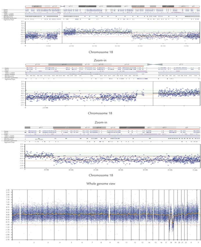 Figure 6. Oligonucleotide-based array comparative genomic hybridization shows a 14.9-Mb deletion (0–14,941,330 bp) of the short arm of chromosome 18 and a 29.6-Mb deletion (46,533,430–76,117,153 bp) of the long arm of chromosome 18.