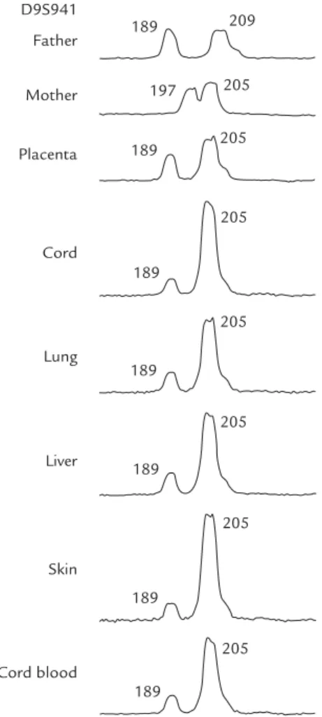 Figure 6. Representative electrophoretograms of quantita- quantita-tive fluorescent polymerase chain reaction assays