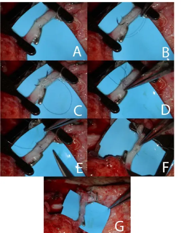 Figure 1. A: Anastomosis of the anterior vessel wall. Two interrupted sutures are applied at 0 0  and 180 0  angle