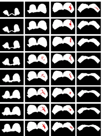 Fig.  1.  The  segmented  fatty  tissue  (white  areas)  and  the  fibroglandular  tissue  (red  areas)  using  by  the  MRI-based segmentation method (Nie et al., 2008)[22]