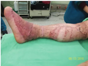Fig. 2. There was no recurrence of infection and  functional outcome of right lower limb was  acceptable after 3 years follow-up
