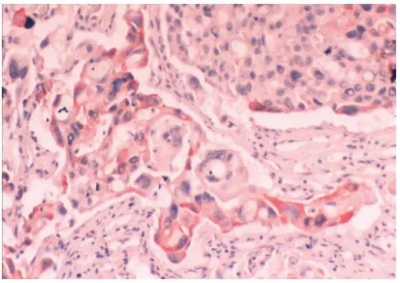 Fig. 1    Representative example of DDH  expression in breast cancer cells detected by immunohistochemistry
