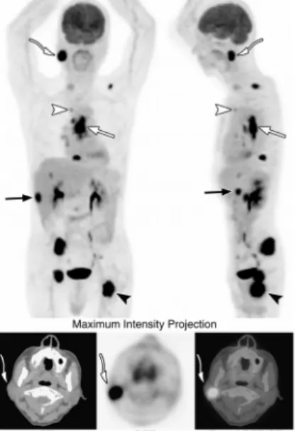 FIGURE 1. A 55-year-old man had middle thoracic esophageal squamous cell carcinoma.