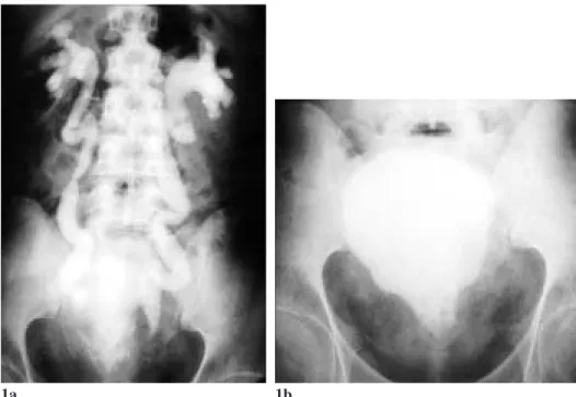 Figure 2. Barium enema study demonstrates straight- straight-ening and elevation of the rectosigmoid colon.