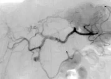 Figure 4. Followed angiography after embolization reveals complete embolization of the pseudoaneurysm.