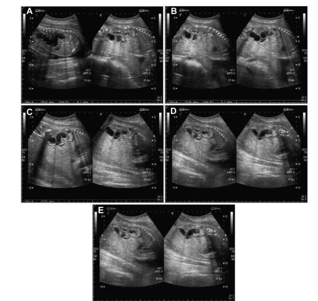 Fig. 1 (A) e(E) Prenatal ultrasound imaging findings at 27 weeks of gestation show a duplex right renal system with the upper kidney having two cysts, hydronephrosis and a tortuous ureter, and the lower kidney having mild hydronephrosis.
