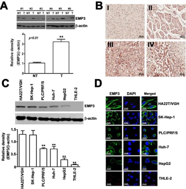 Figure 1: EMP3 is highly expressed in tissue sections from HCC patients and in HCC cell lines