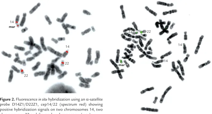 Figure 2. Fluorescence in situ hybridization using an  α-satellite probe D14Z1/D22Z1, cep14/22 (spectrum red) showing positive hybridization signals on two chromosomes 14, two chromosomes 22 and the marker chromosome (mar).