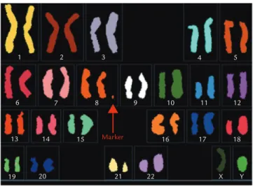 Figure 3. Spectral karyotyping using 24-color sky probe shows an sSMC derived from chromosome 8.