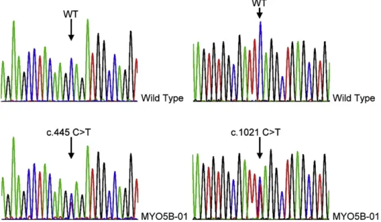Fig. 1. Compound heterozygous nonsense mutation of c.445C >T, p.Q149X in Exon 4 and c.1021C>T, p.Q341X in Eexon 9 of the MYO5B gene in the fetus.