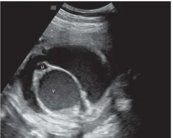 Figure 1. Prenatal ultrasound at 29 weeks of gestation show- show-ing fetal ascites with an intraabdominal echogenic cystic mass