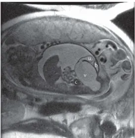 Figure 3. Magnetic resonance imaging showing a com- com-pressed urinary bladder (b), a distended vagina (v), a dilated uterus (u) and a dilated distal colon (c).