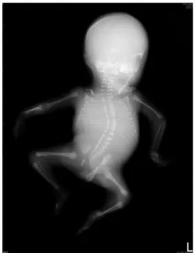 Fig. 3 Fetus at birth. Fig. 4 Radiography shows severe kyphoscoliosis.