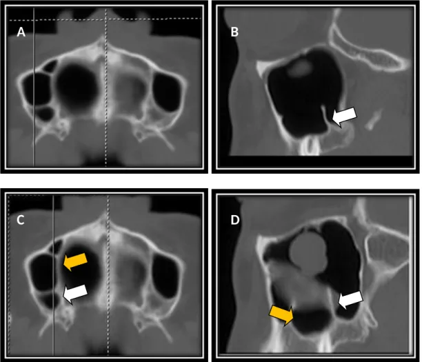 Figure 1. The CT images from the axial plane (A and C) and from the sagittal plane  (B and D) - The presence of septum is determined by the observation of the complete  compartments divided by bony structure on the axial view, and the finding of a crest-  